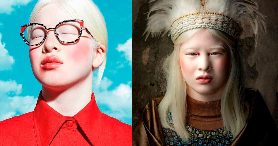 A modelo albina da Vogue que foi abandonada quando bebê