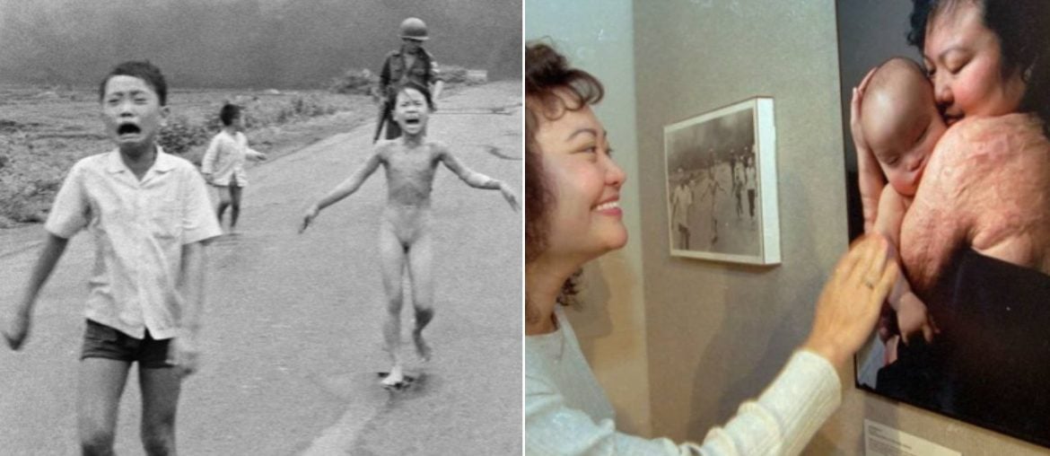 ‘Menina do Napalm’ recebe último tratamento 50 anos após foto que chocou o mundo